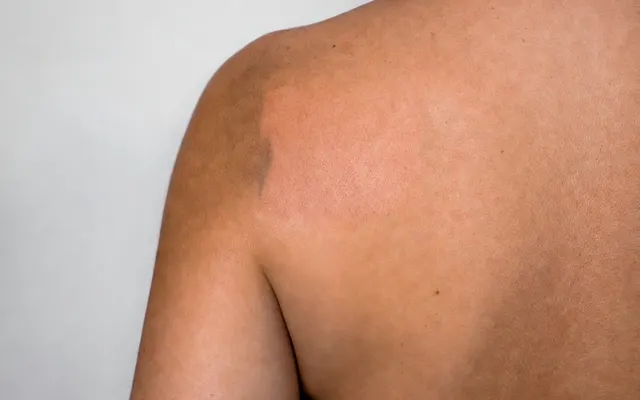 Remove Tattoo